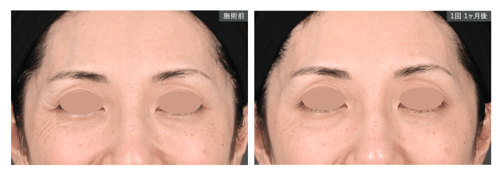 ④ 肌育注射（リジュラン・女優注射など）