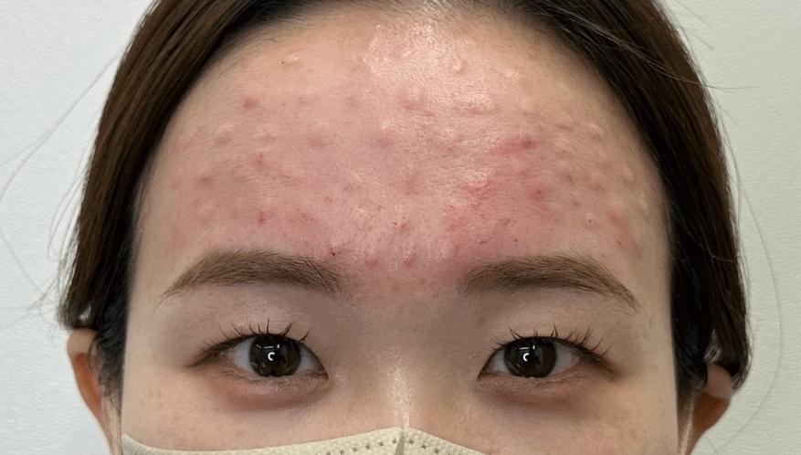 <b>◆ 施術直後（0時間）</b>