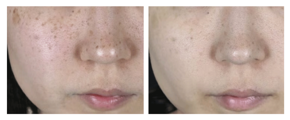 ⑥ 美肌レーザー