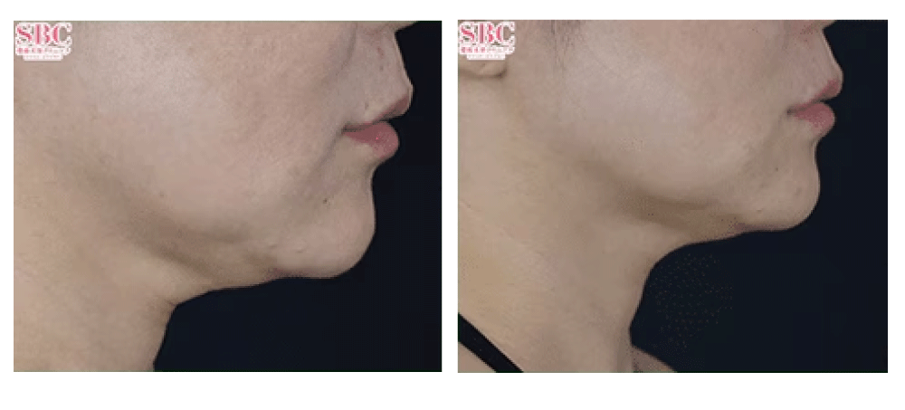 ⑤ 脂肪溶解注射（口横・フェイスライン）