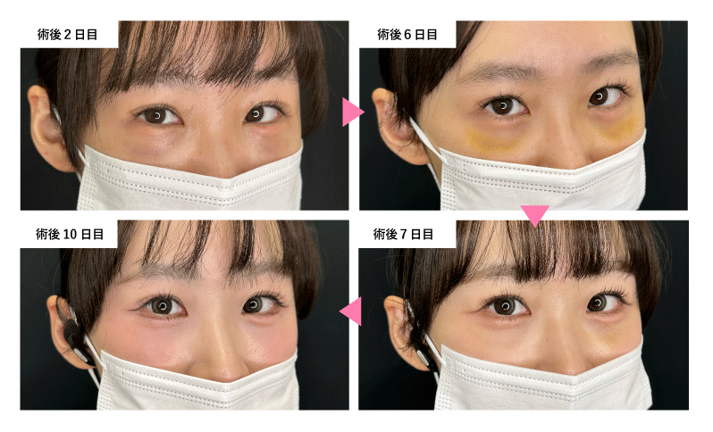 ダウンタイム中の過ごし方