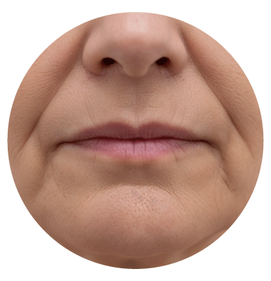 【タイプ①】たるみ型ほうれい線