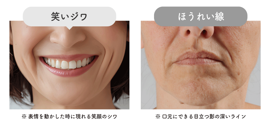 Q.ほうれい線と笑いジワは違う？