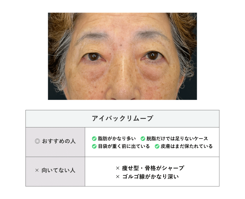 アイバックリムーブ法