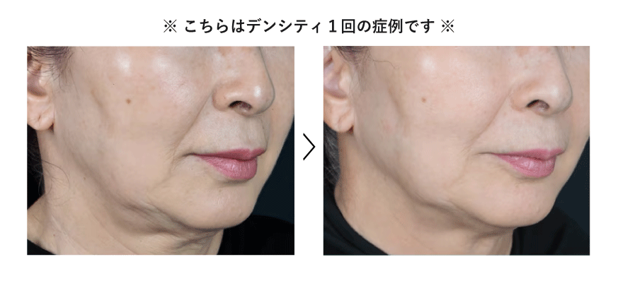 <b>STEP2：引き上げる前に“引き締める”</b>