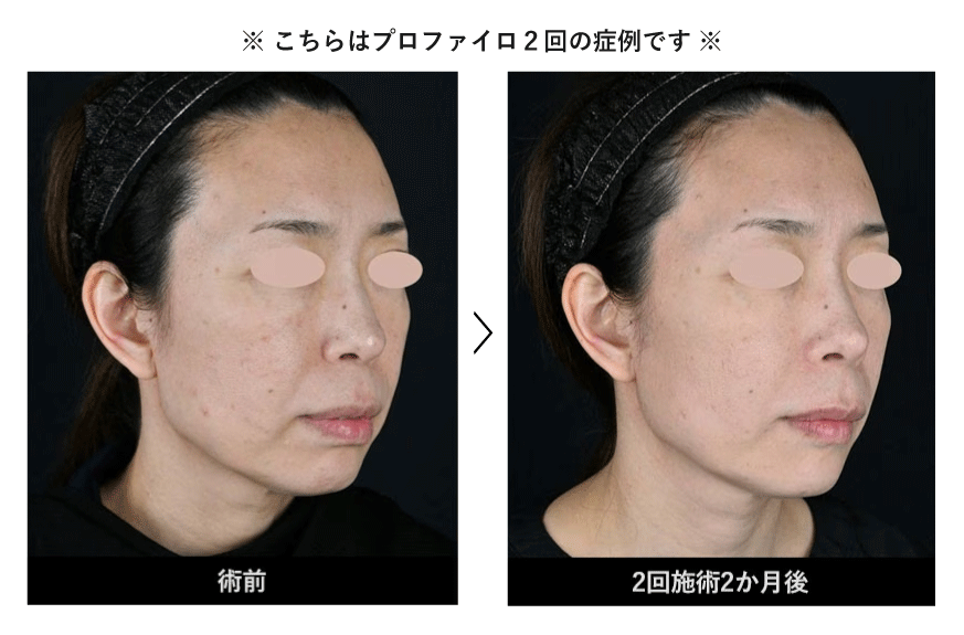 <b>STEP1：若返りの土台は「肌質改善」</b>