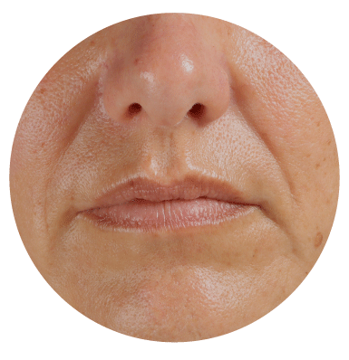 【タイプ②】くぼみ・骨格型ほうれい線