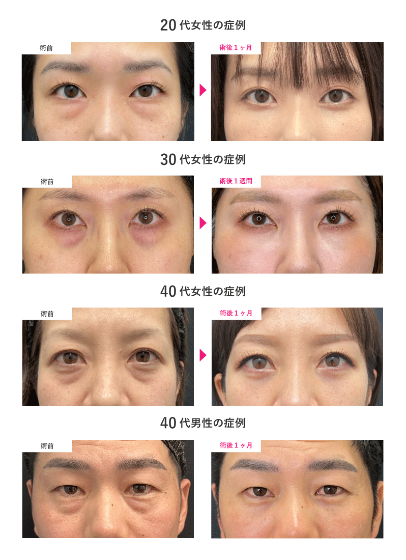 年齢別｜山口院長のクマ取り症例