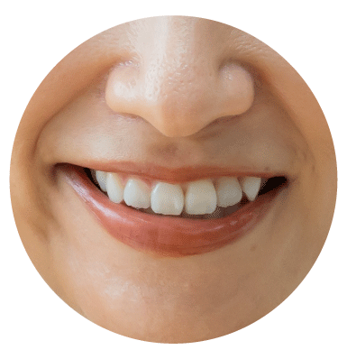 【タイプ③】筋肉型ほうれい線