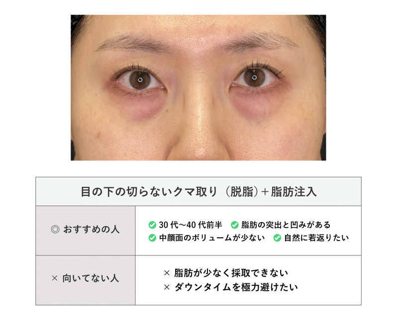 目の下の切らないクマ取り＋脂肪注入