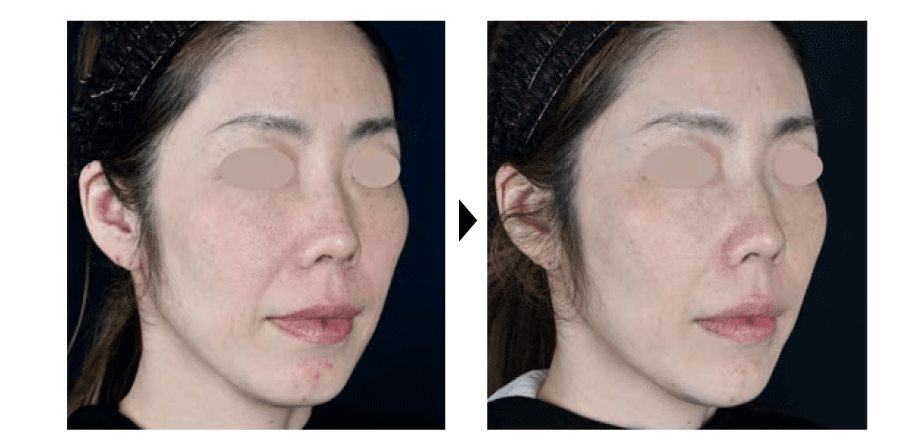 Q. 貴族ヒアルって危険？！