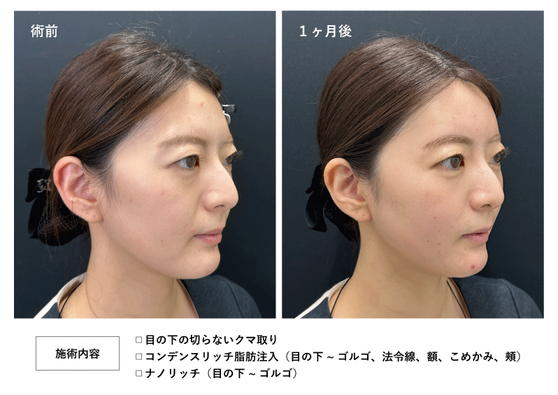 <b>STEP3：老け顔の正体「影」を消す</b>