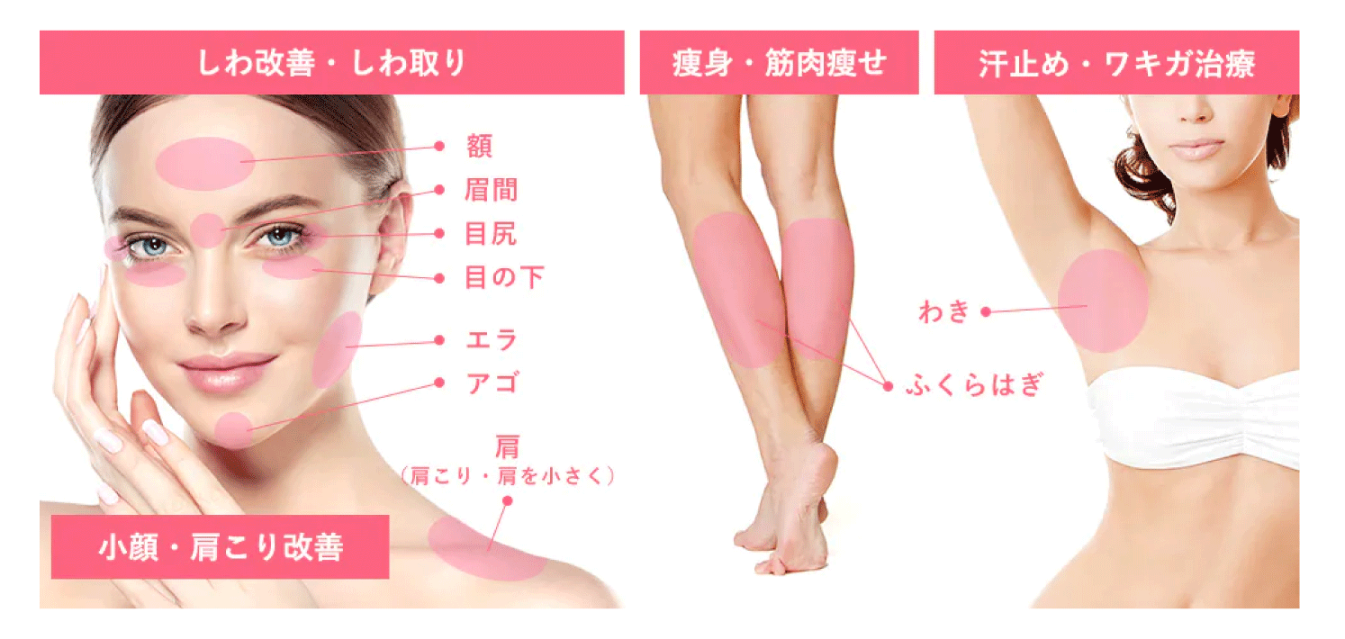 ボトックスで改善できる部位