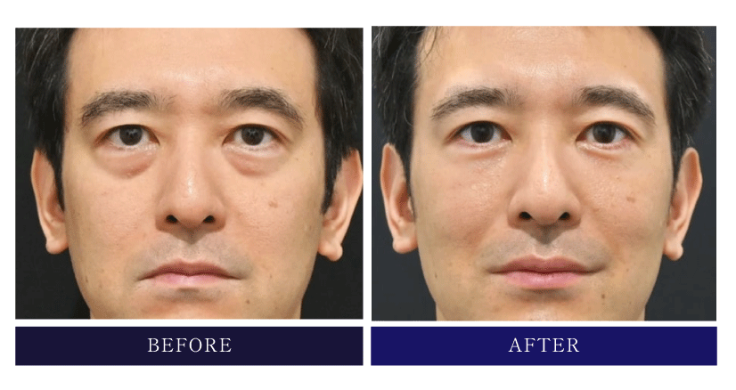 ③ クマ取り｜疲れて見える目元を改善