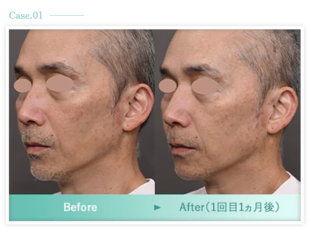 まずは”フォトジェネシス”の症例写真をご覧ください