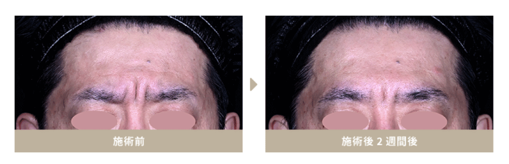 ① ボトックス｜若返り