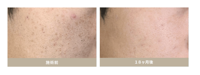 ⑤ 肌管理（フォト治療・ピーリング）