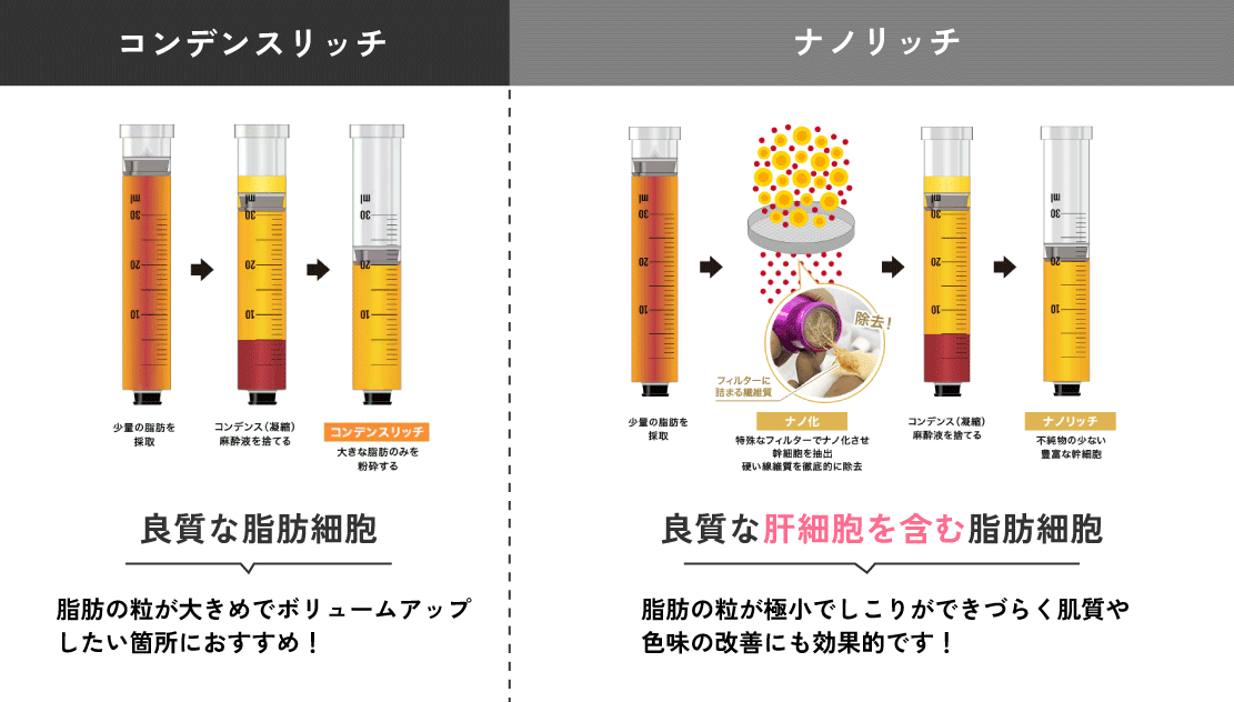 脂肪注入の種類と効果（コンデンスリッチ・ナノリッチ）