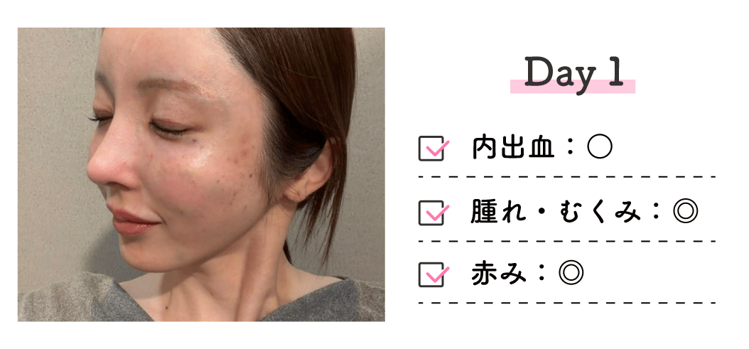 ■ 施術直後（Day1）