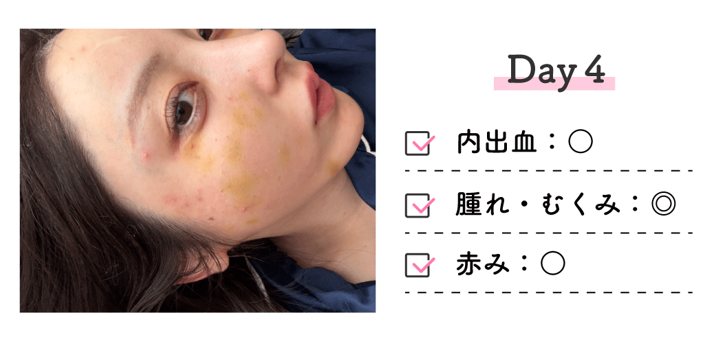 ■ 4日後（Day4）