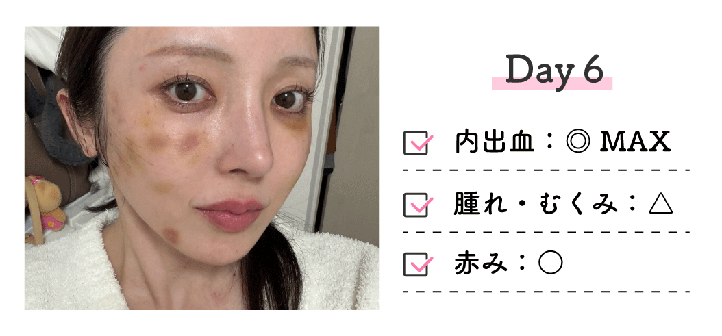 ■ 6日後（Day6）