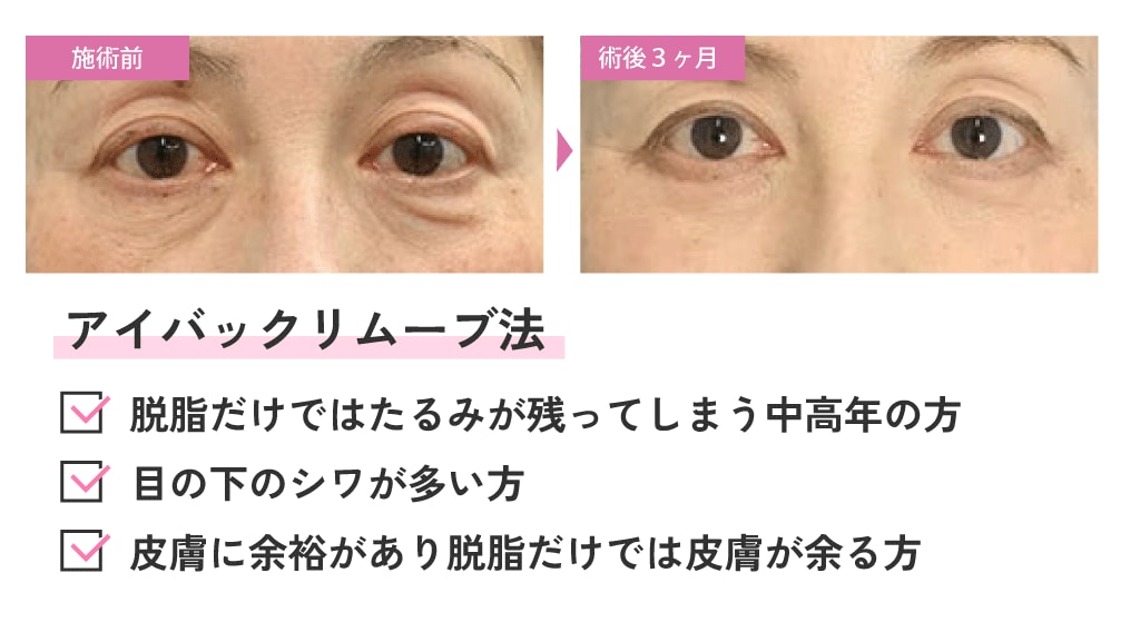 アイバックリムーブ