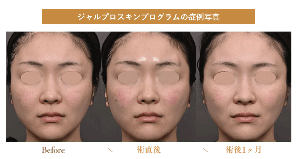 ジャルプロスキンプログラム症例写真