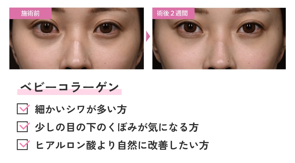 ベビーコラーゲン注射