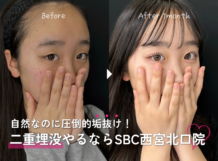 【症例多数】神戸・西宮で二重整形ならSBC西宮北口院|自然で可愛い仕上がりの理由を徹底解説
