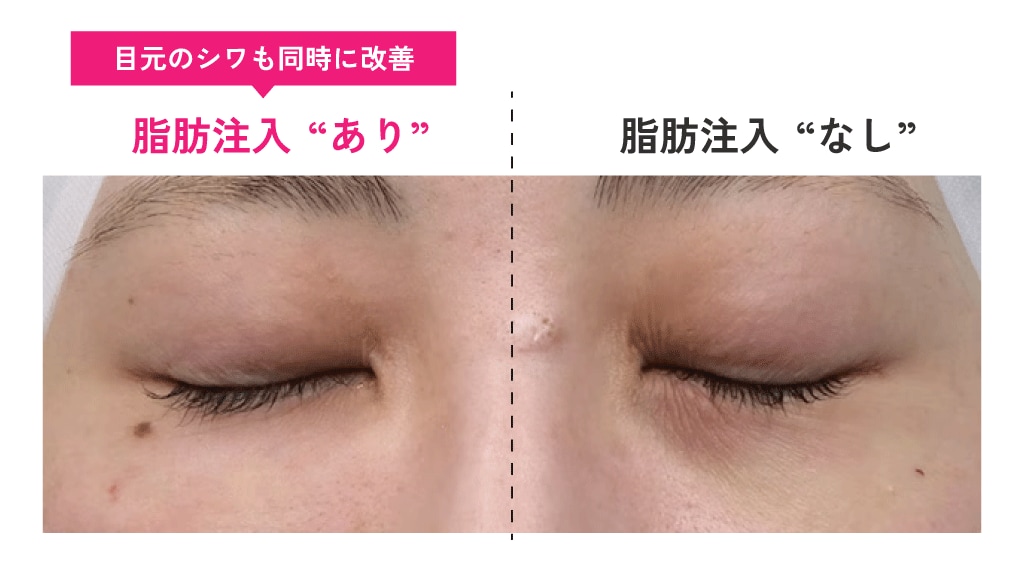 「膨らみ」が治っても「凹み」が残れば、目元のクマは改善できていません！