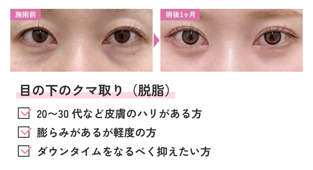 目の下の切らないクマ・たるみ取り（目袋３脂肪の脱脂）