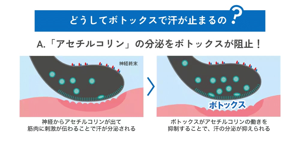 注射で汗とニオイを抑える簡単治療