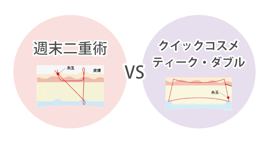 どっちがいい？人気の二重術を比較