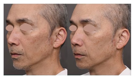 毛穴の開きや小じわ改善におすすめ<b>「フォトジェネシス」</b>