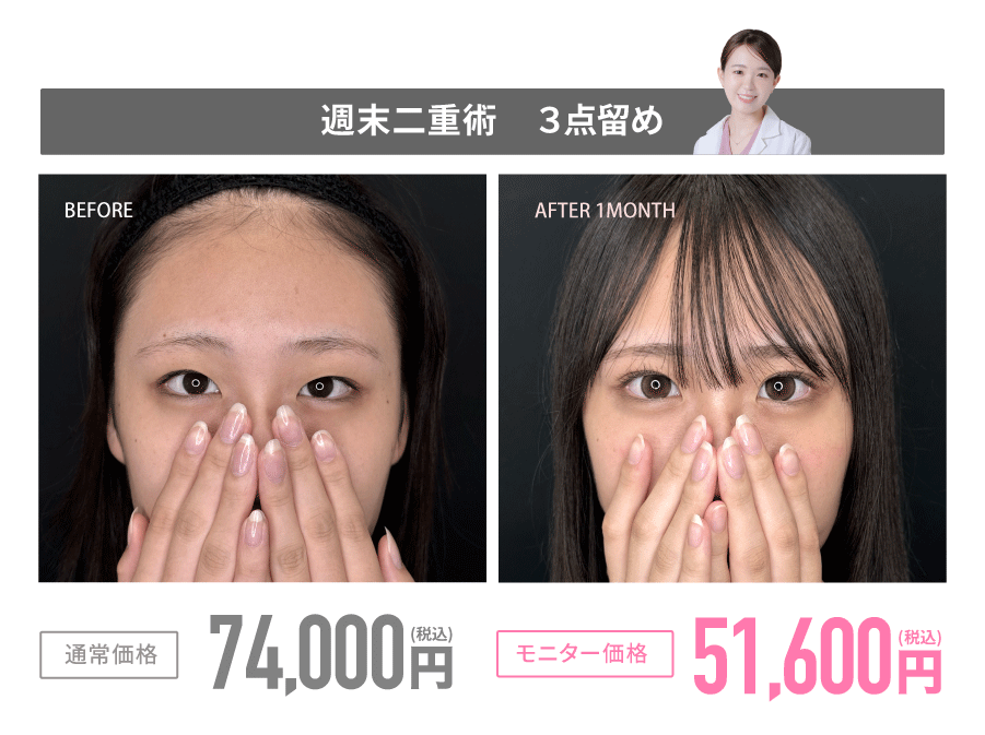 週末二重術とは