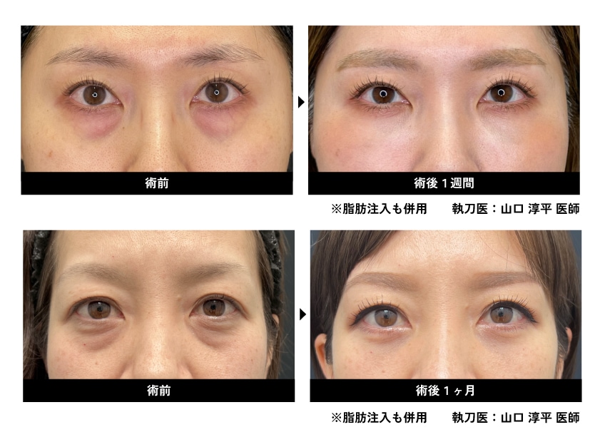 脱脂術の症例写真
