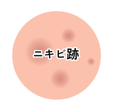 ④ニキビ跡・クレーターが気になる