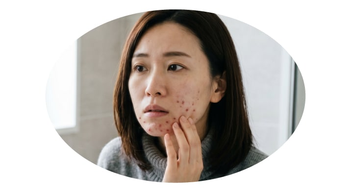 大人ニキビ