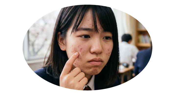 10代ニキビ