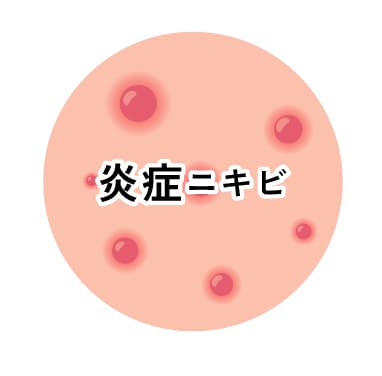 ②炎症ニキビ（赤ニキビ）が多い