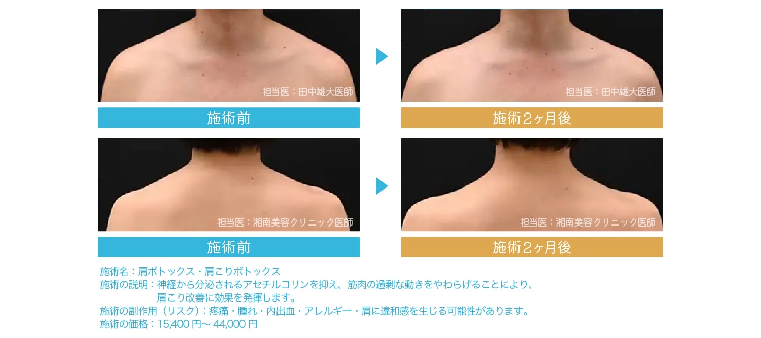 肩の筋肉が小さくなることで華奢見えを叶えます！
