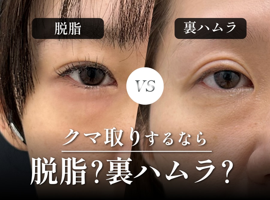 【神戸・西宮】目の下のクマ取りは脱脂と裏ハムラどっちがおすすめ?違いや向いている人を徹底比較