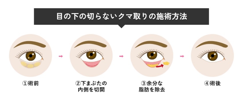 目の下の切らないクマ取り（脱脂）とは？