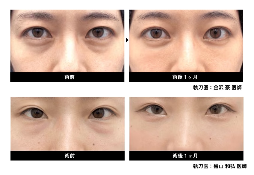 裏ハムラ法の症例写真