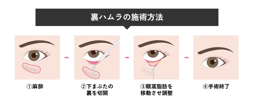 裏ハムラ法とは？