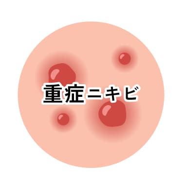 ③何年も治らない重症ニキビ