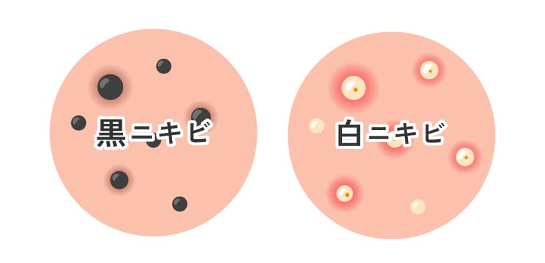 ①皮脂が多く白ニキビ・黒ニキビができやすい
