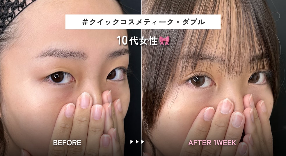 5.すっぴんでも自然に映えるMIX型二重