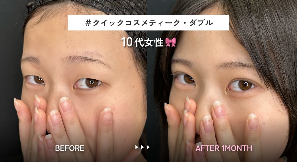 4.自然に目を大きくする平行型二重