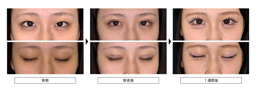 2.休みが取れてなるべく安く二重になるなら「TEEN二重術」
